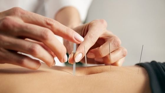 Aghi di agopuntura intradermici cosmetici e medici Struttura dritta che garantisce sicurezza ed efficacia nell'agopuntura